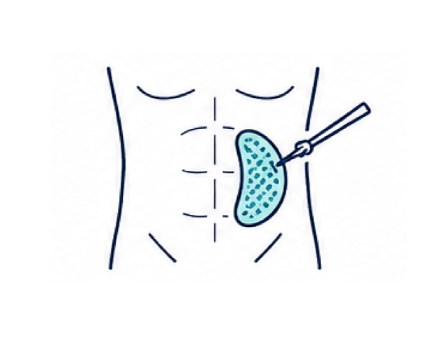 Home 10 Abdominal wall hernia surgery