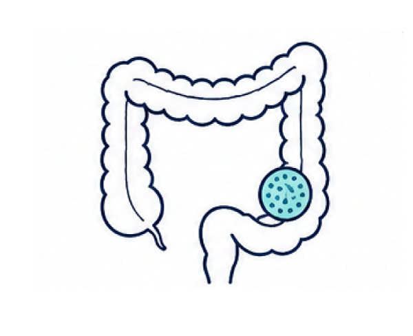 Home 8 Colon and rectal cancer