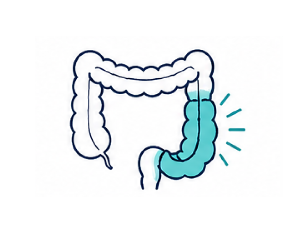 Home 14 Inflammatory bowel surgery