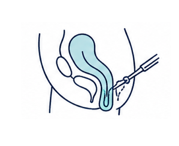 Home 11 Rectal prolapse surgery and Pelvic floor disorders