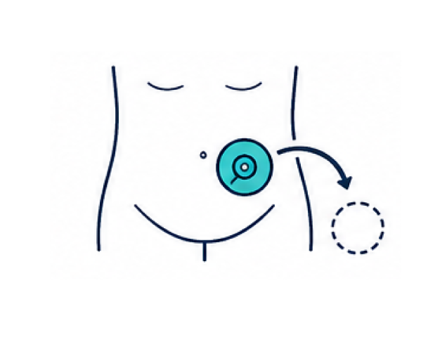 Home 13 Stoma correction Reversal surgery